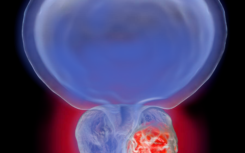 Prostatos vėžys: nuo PSA rodiklio prie individualios rizikos vertinimo